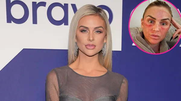 'Vanderpump Rules' Star Lala Kent Shares Photo of Her Bruised Face After Microneedling Procedure - 196
