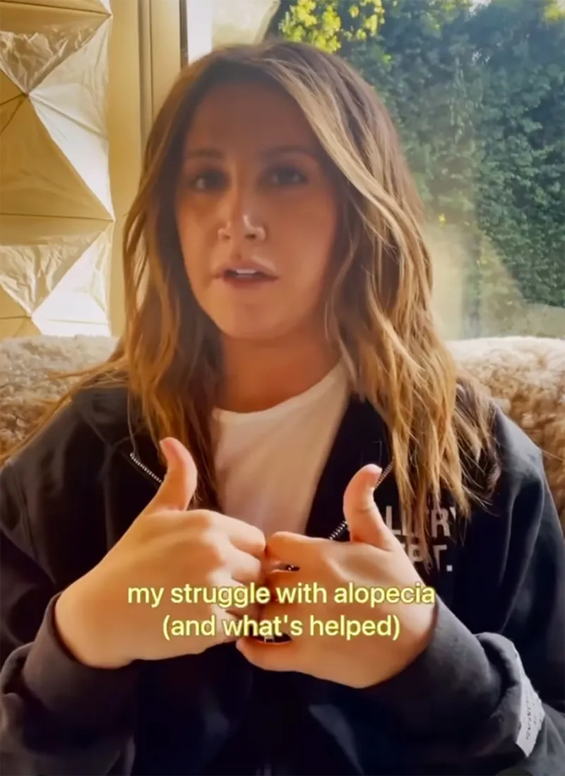 Ashley Tisdale Reveals Alopecia Diagnosis instagram