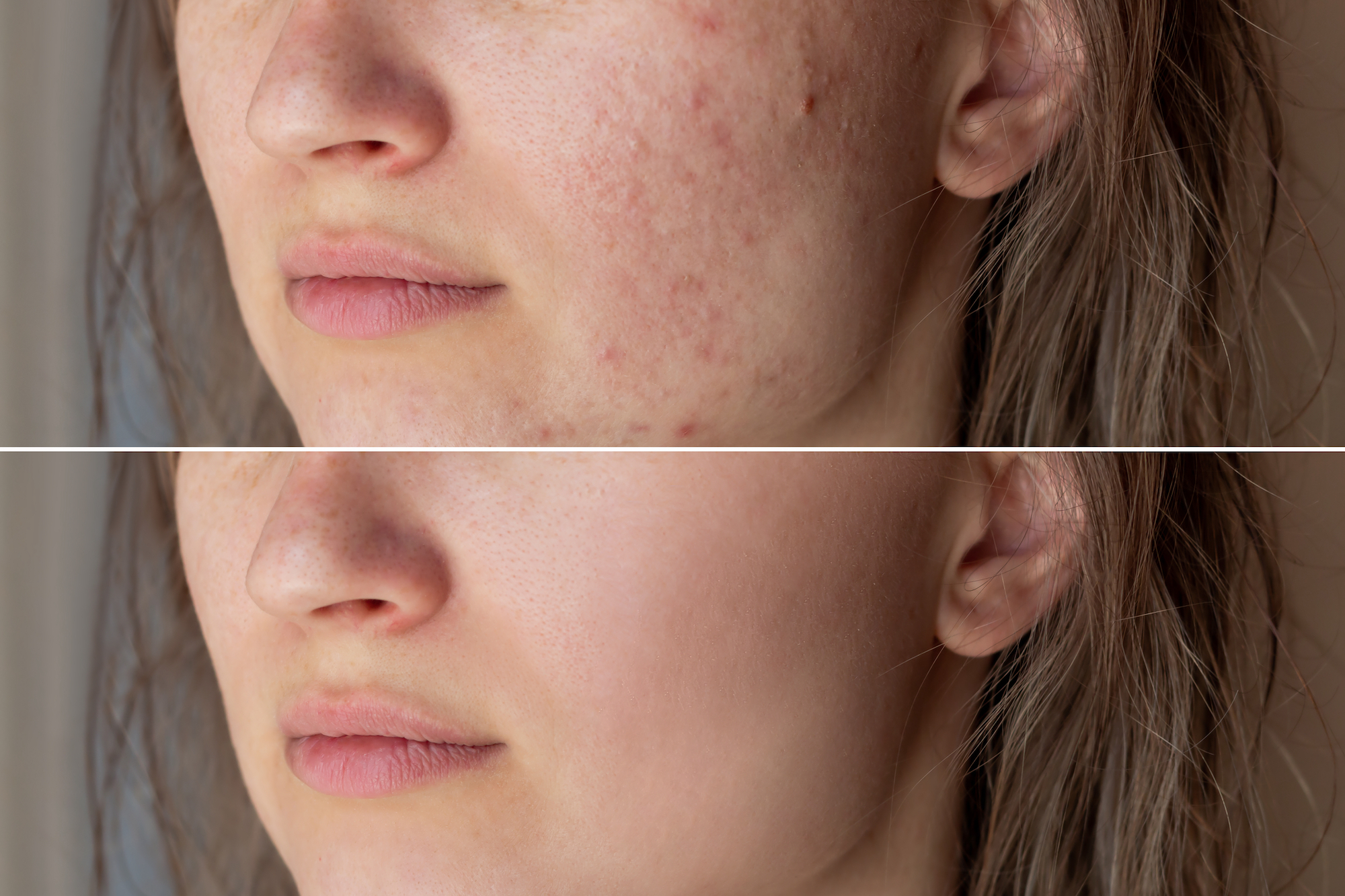 Before-After-Acne-Skin-Stock-Photo