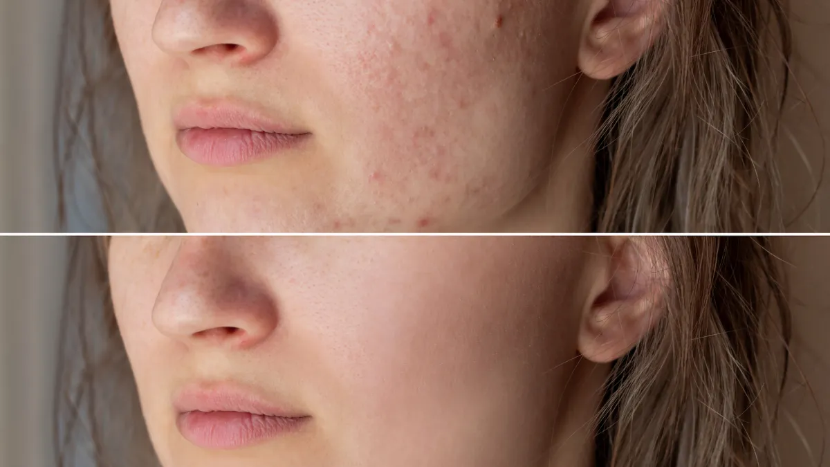 Before-After-Acne-Skin-Stock-Photo