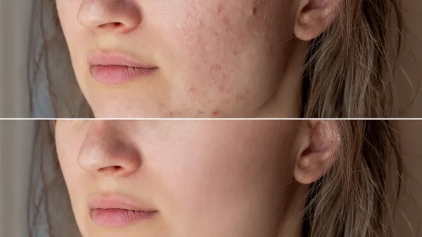 Before-After-Acne-Skin-Stock-Photo