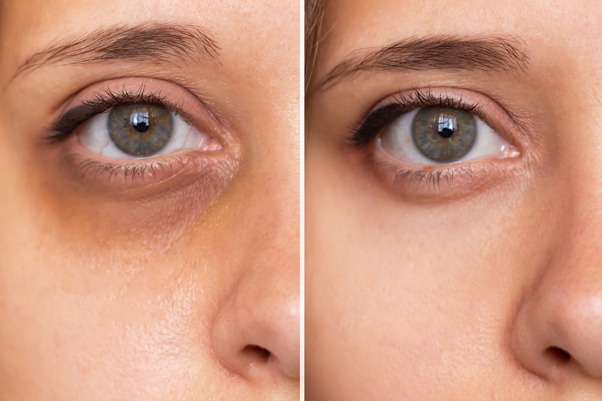 Dark-Circle-Before-After-Treatment-Stock-Photo