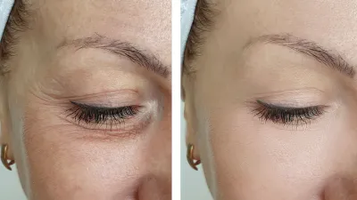 Upper-Eye-Lift-Treatment-Stock-Photo