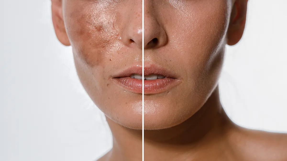 exponent-vitamin-c-skincare-system-hyperpigmentation