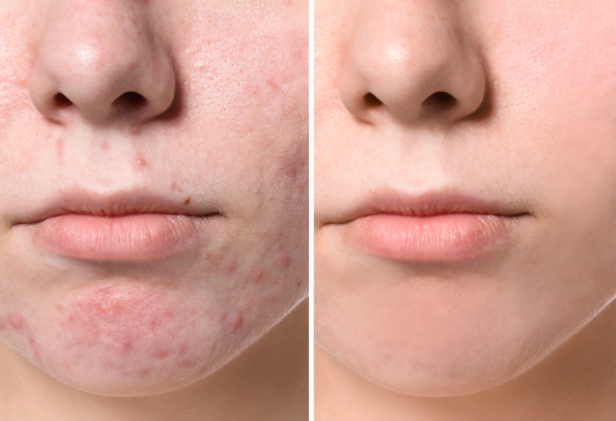 Before-After-Acne-Serum-Stock-Photo