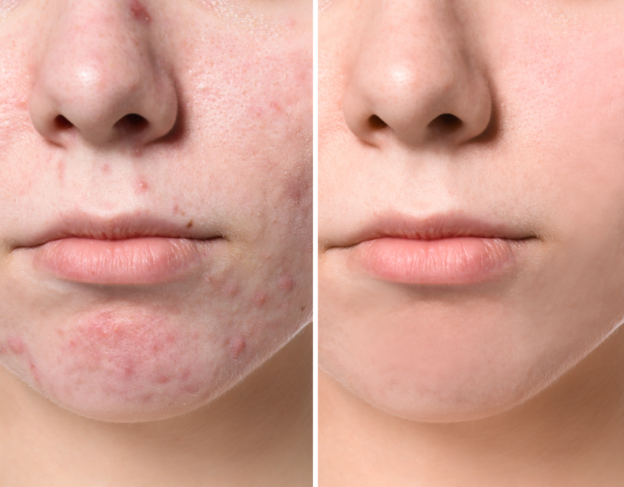 Before-After-Acne-Treatment-Stock-Photo