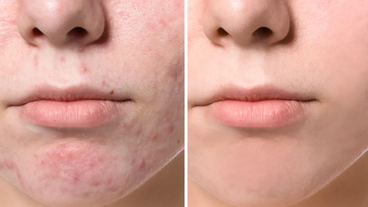 Before-After-Acne-Treatment-Stock-Photo