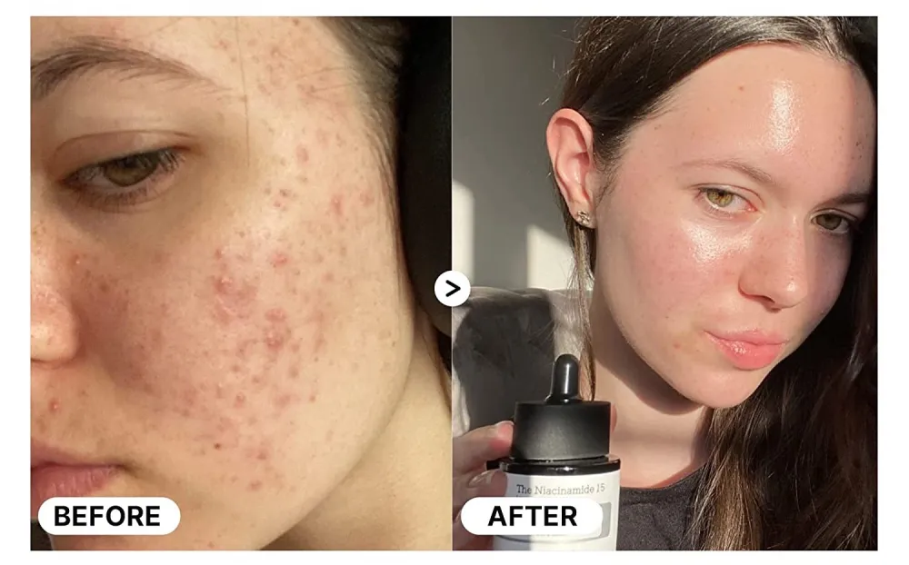 COSRX Niacinamide 15% Face Serum