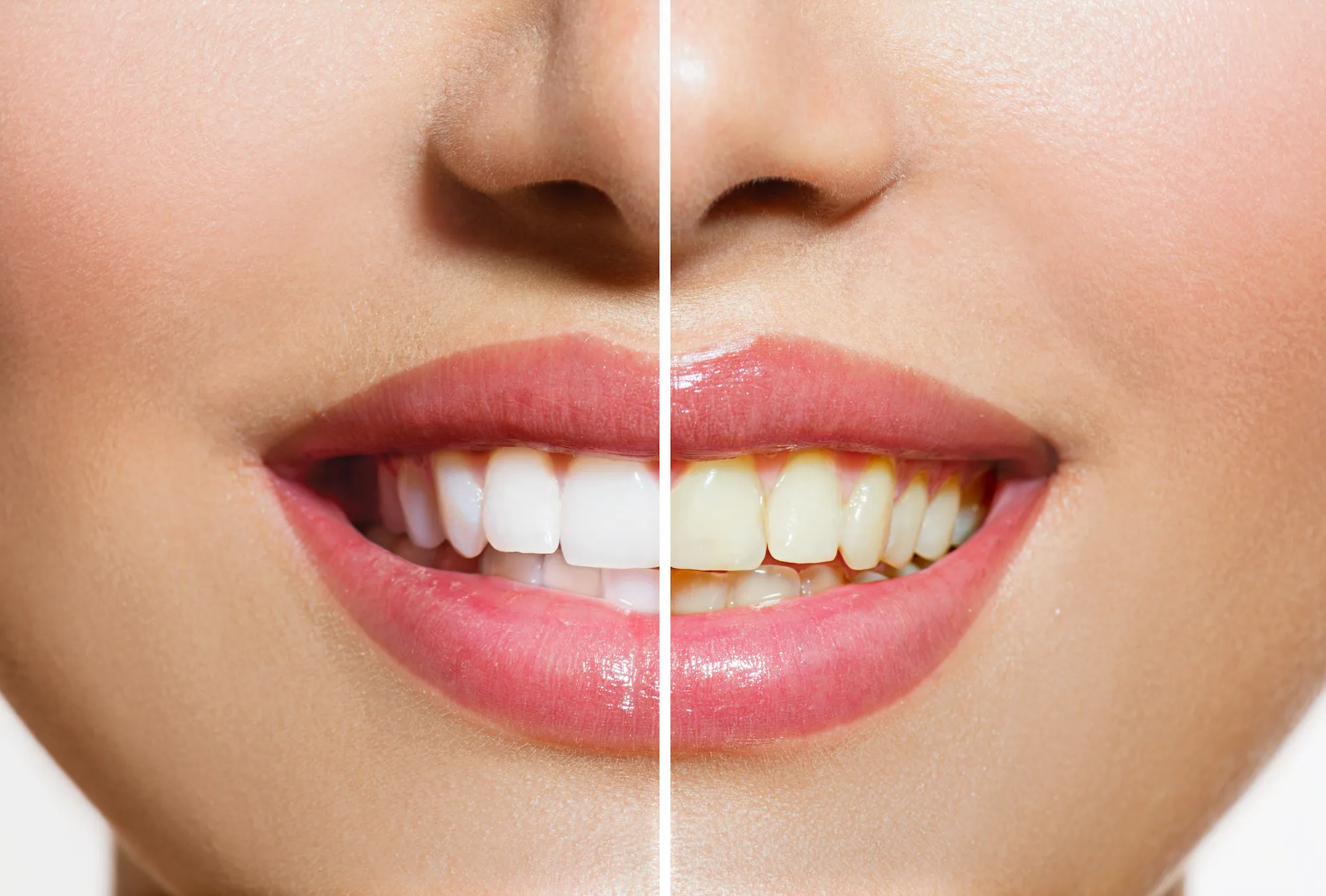 Whitening-Treatment-Before-After-Stock-Photo