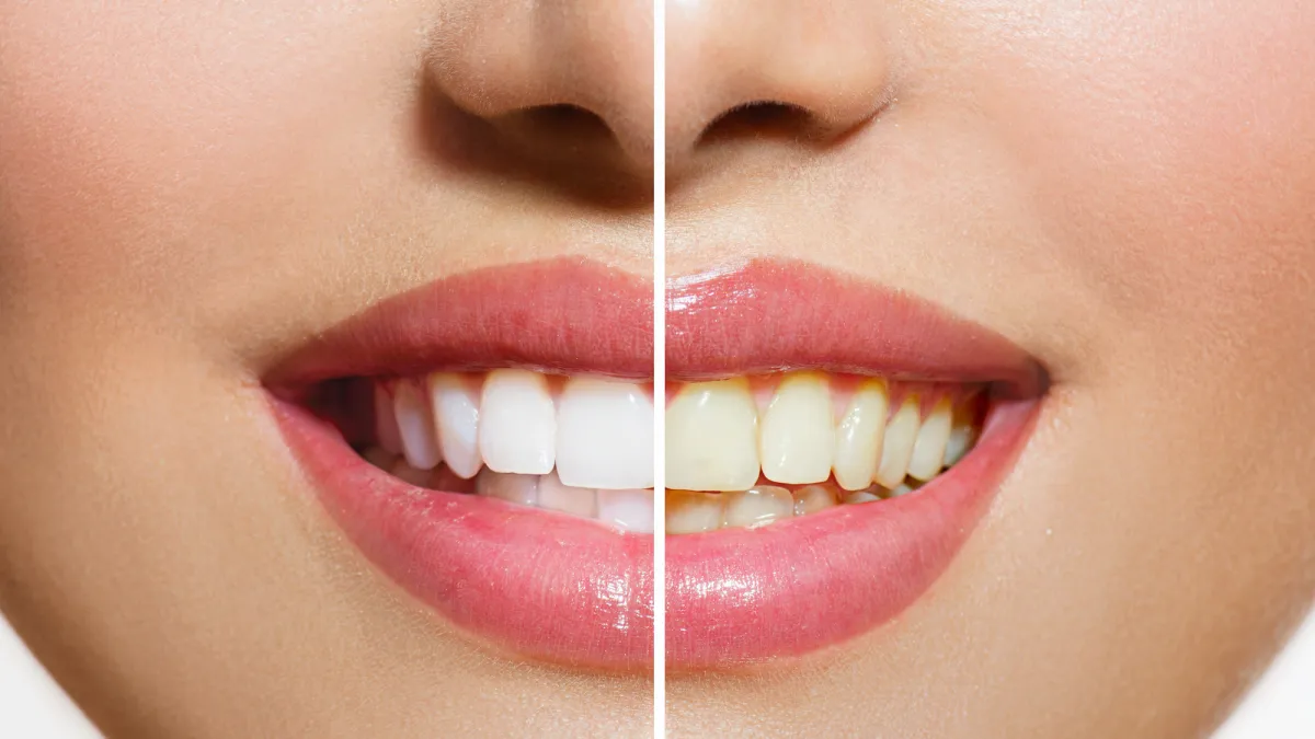 Whitening-Treatment-Before-After-Stock-Photo
