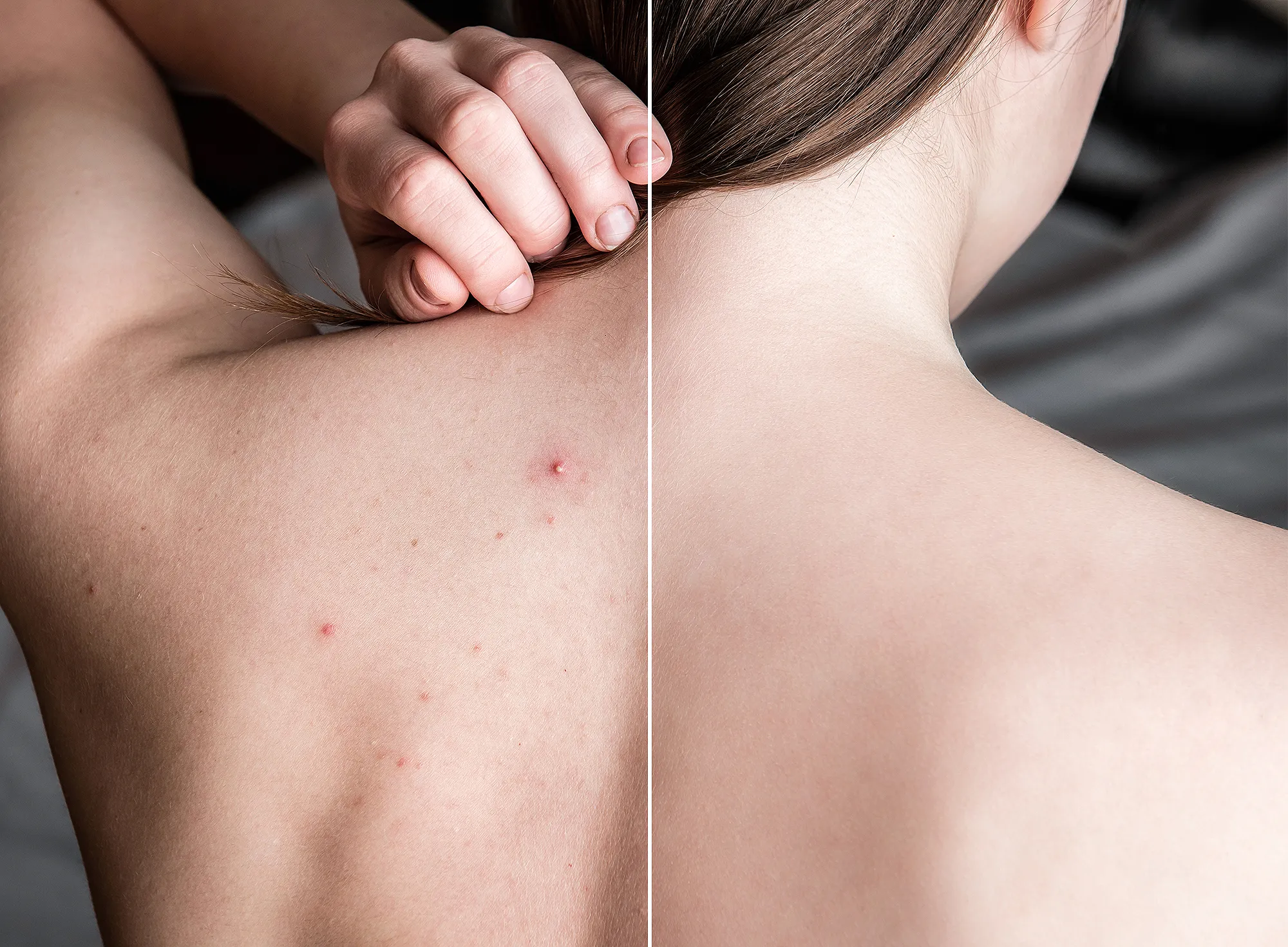 body-acne-before-after