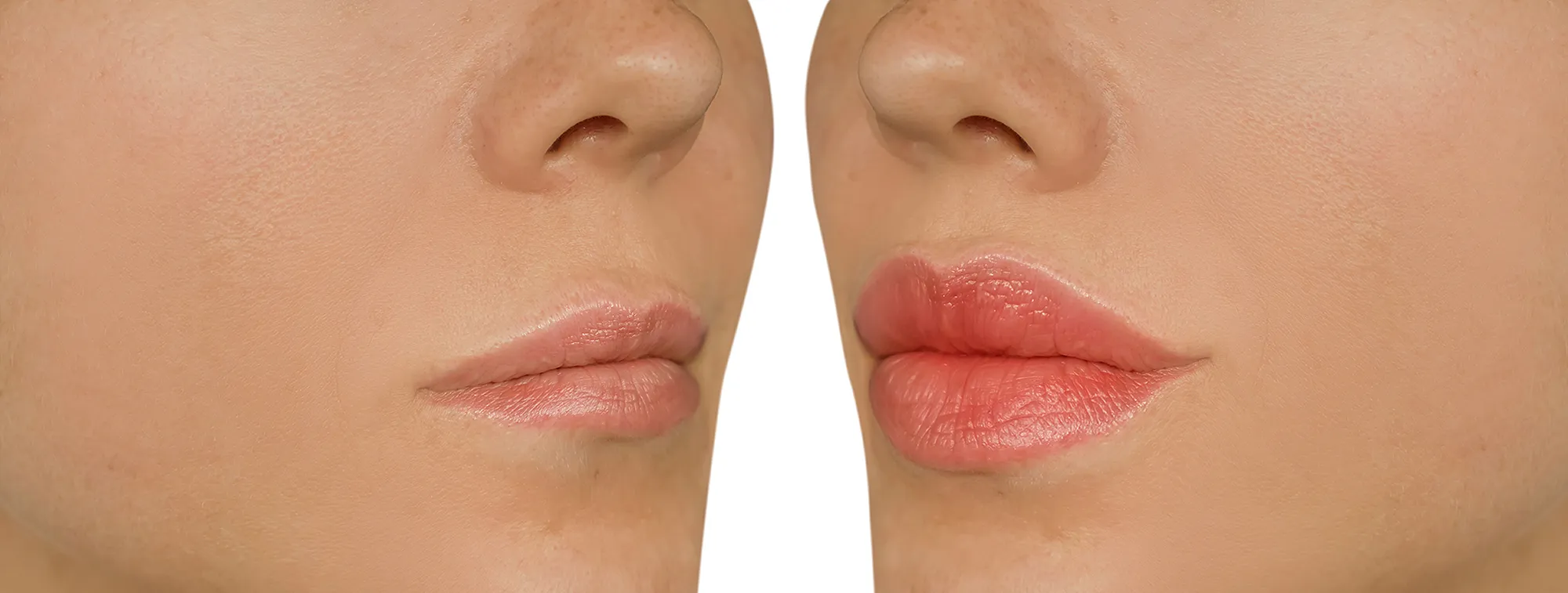 plump-lips-before-after