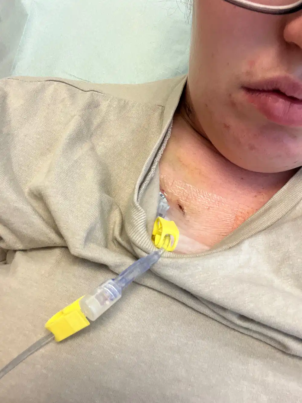 Anna 'Chickedee' Cardwell Shows Hair Loss After Revealing Stage 4 Cancer Diagnosis