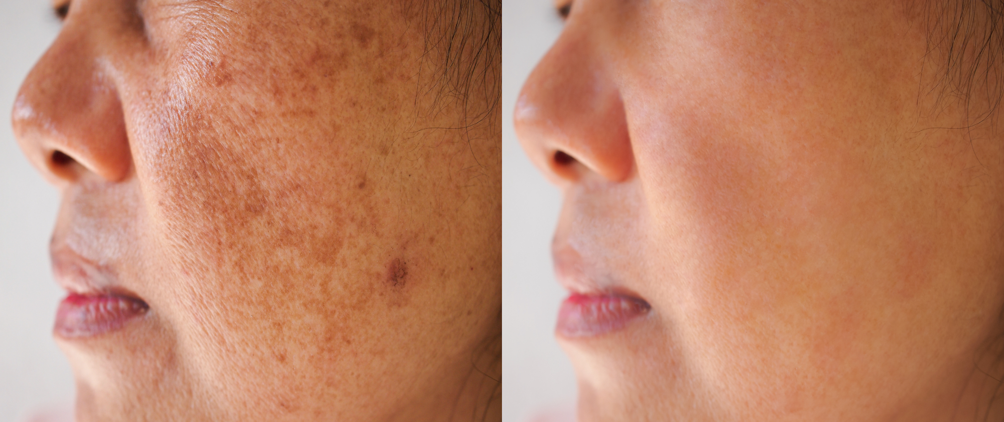 Dark-Spot-Before-After-Stock-Photo