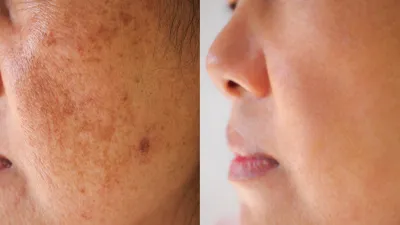 Dark-Spot-Before-After-Stock-Photo
