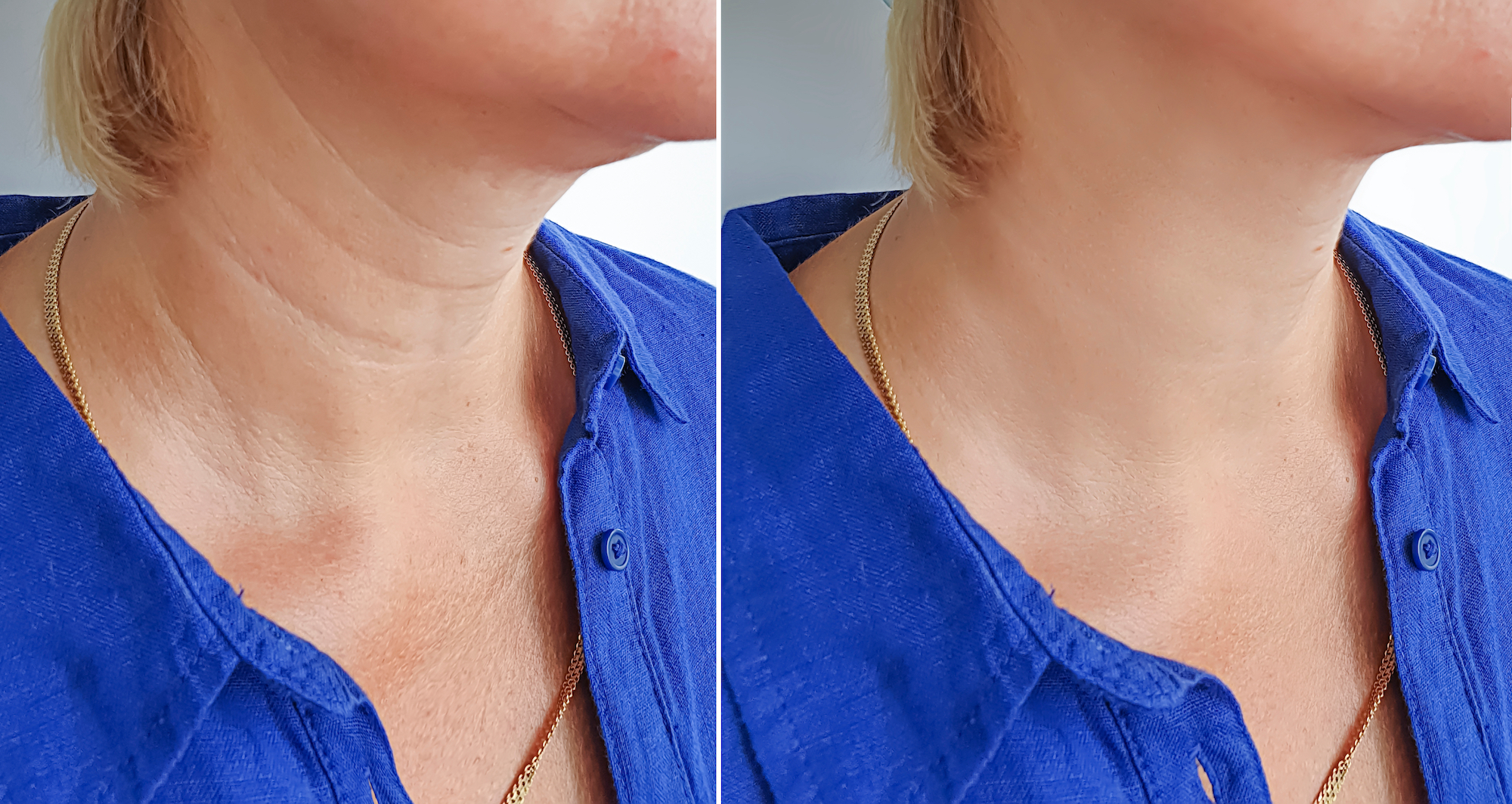Neck-Tightening-Before-After-Stock-Photo