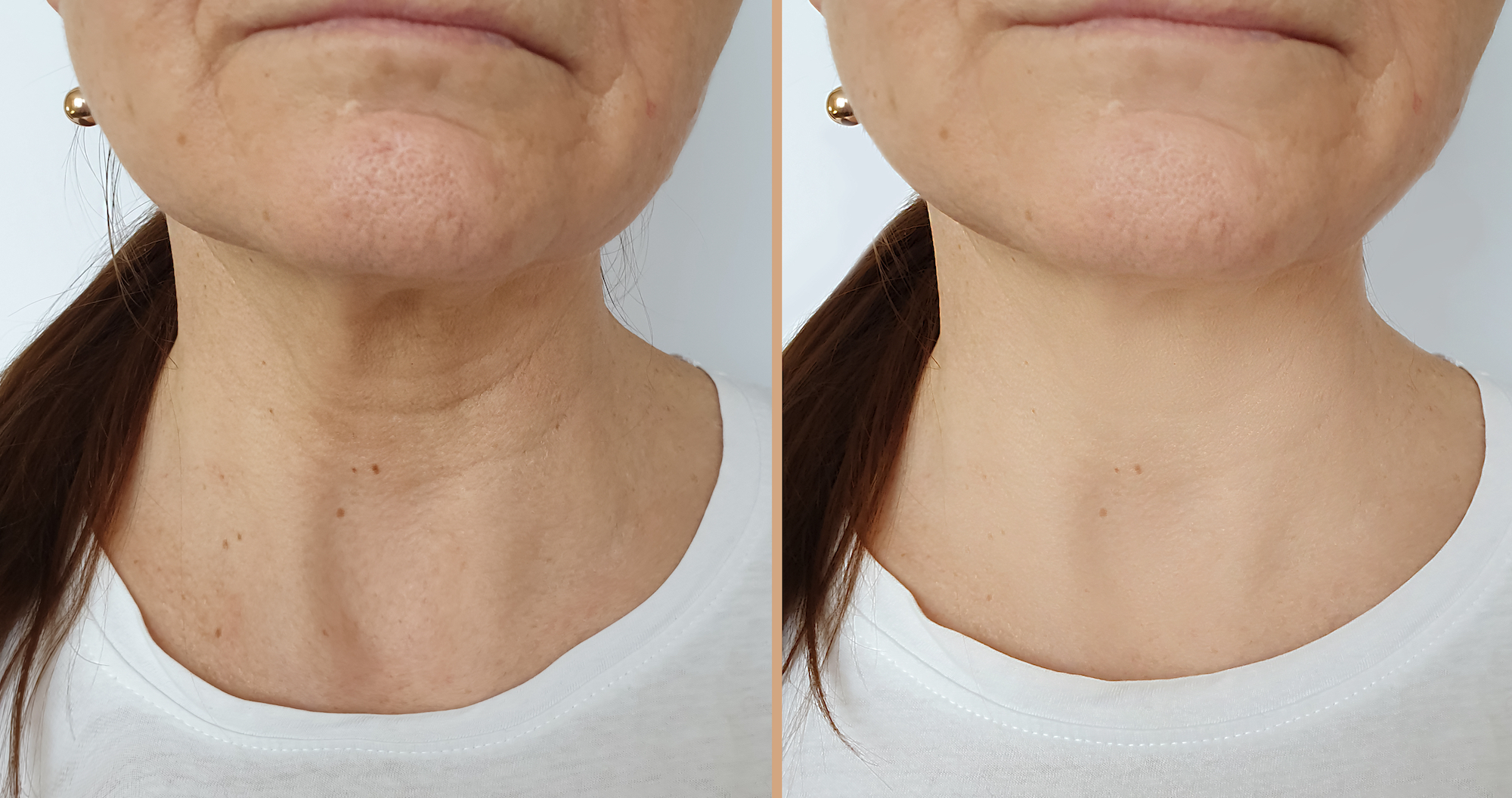 Neck-Wrinkles-Before-After-Stock-Photo