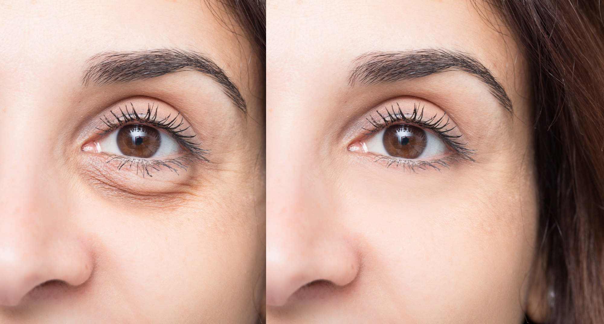 Puffy-Eye-Before-After-Stock-Photo