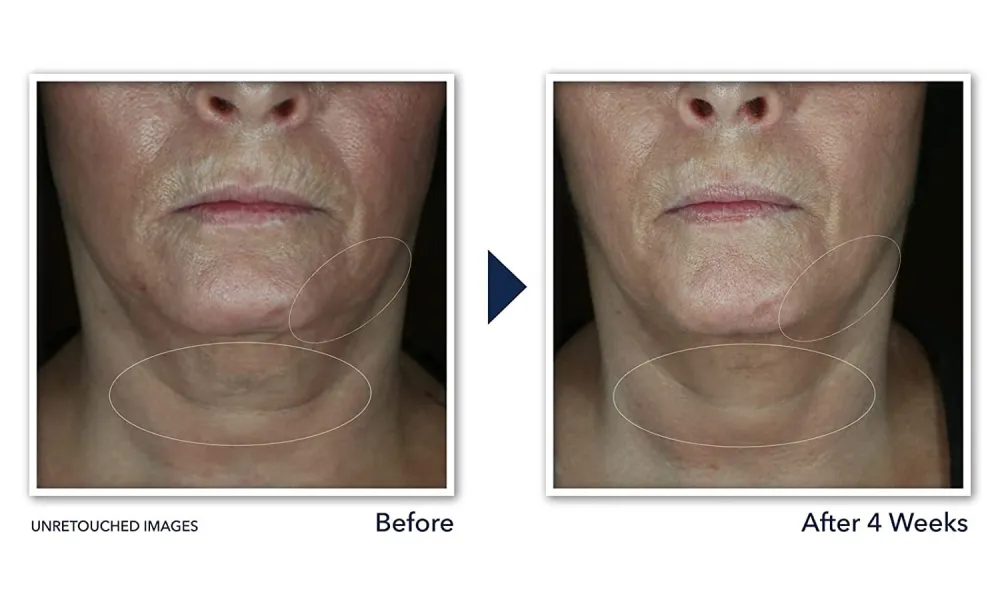 RoC Derm Correxion Neck Cream