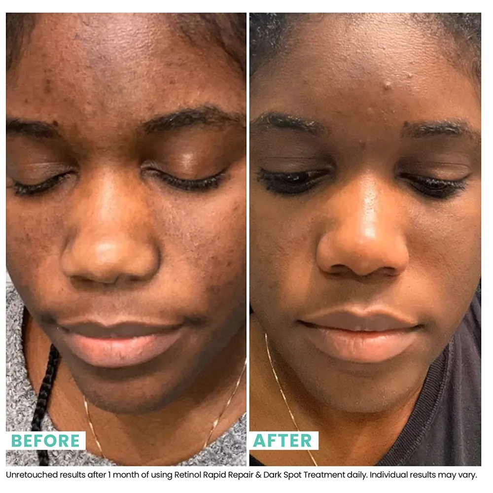 Urban Skin Rx&reg; Retinol Rapid Repair and Dark Spot Treatment