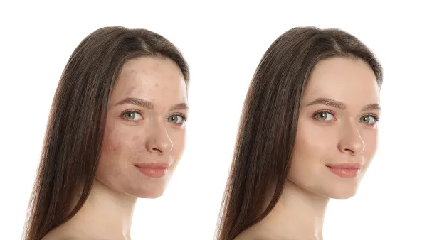 before-after-skincare