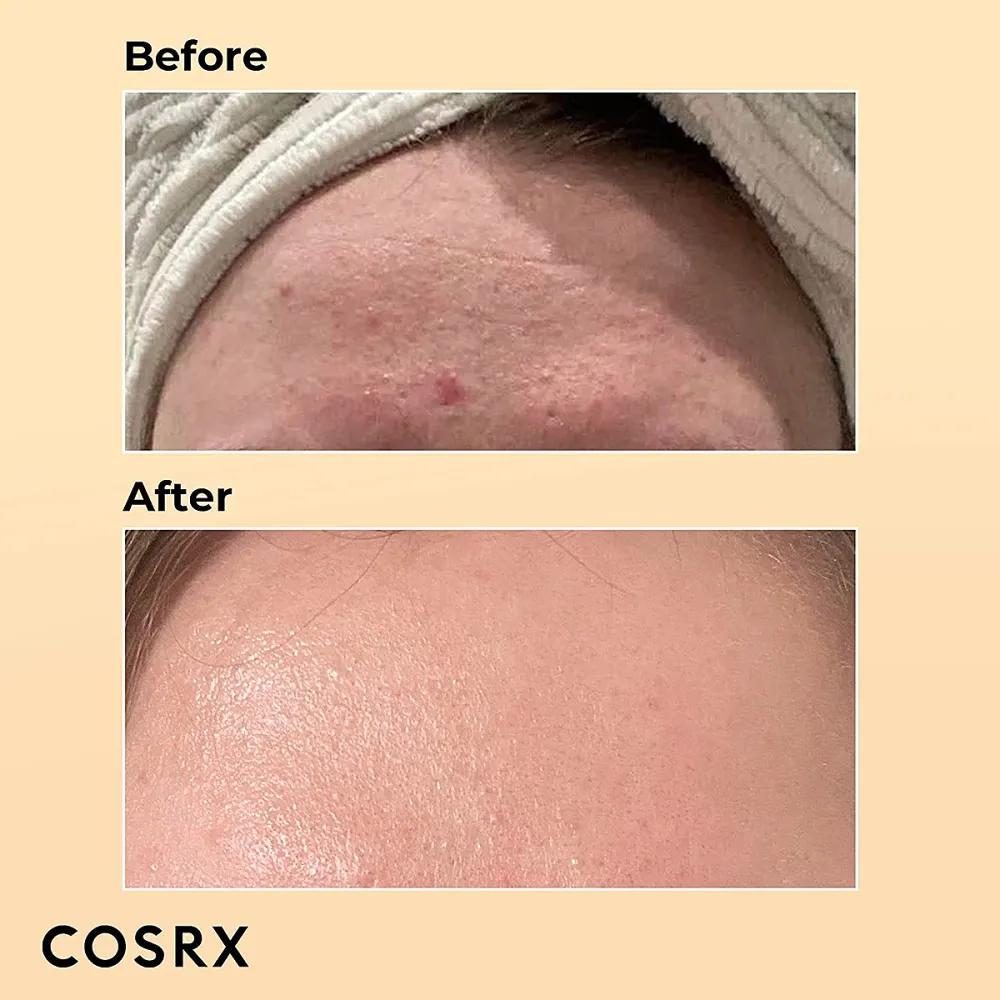 cosrx-snail-mucin-essence-before-after