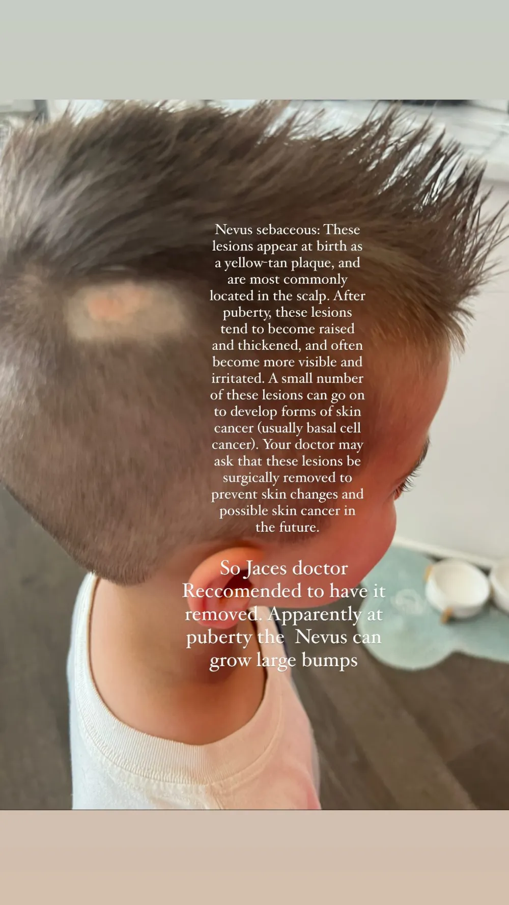 Jana Kramer&rsquo;s Son Jace Recovering After Nevus Sebaceous Surgery