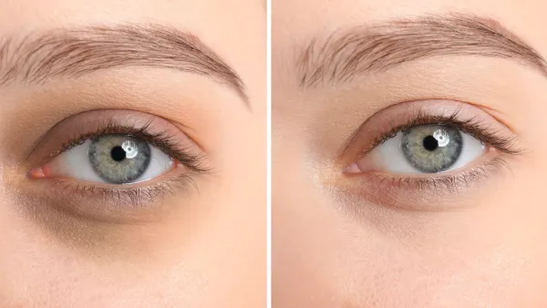 Before-After-Dark-Circle-Stock-Photo