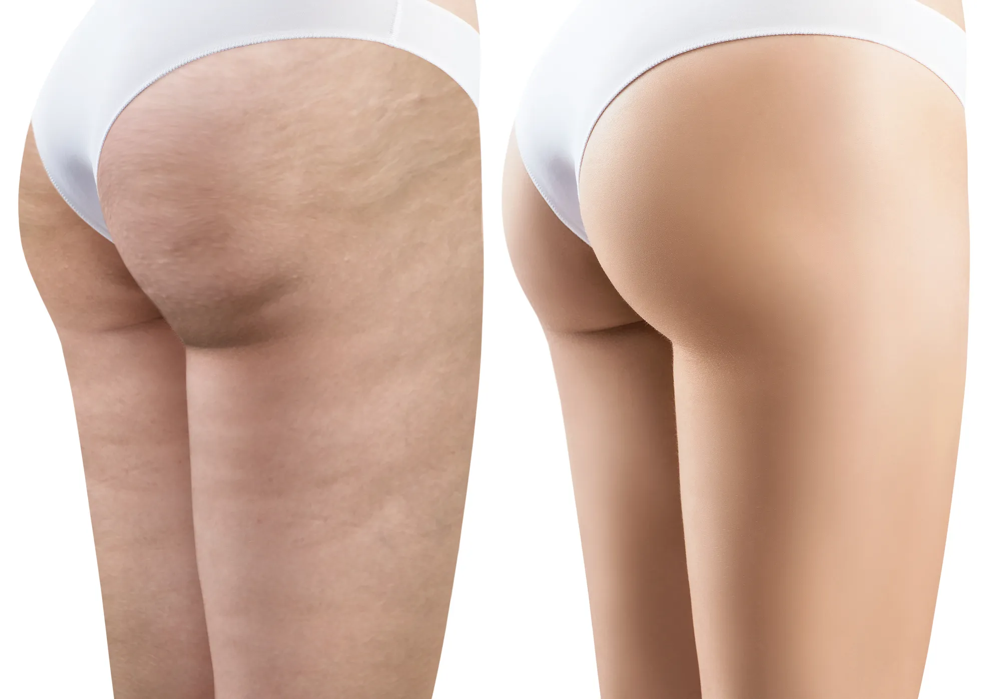 Cellulite-Before-and-After-Stock-Photo
