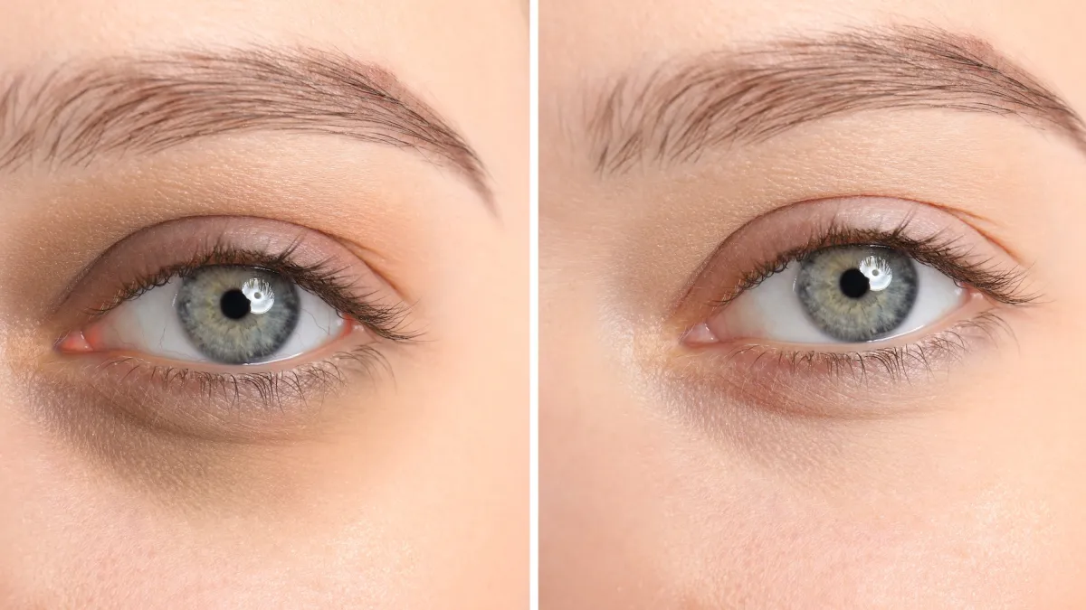 Dark-Circle-Before-After-Stock-Photo