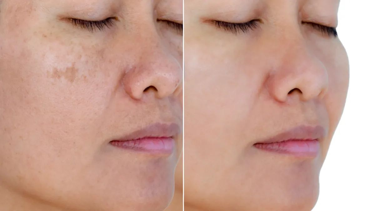 Dark-Spot-Before-After-Stock-Photo