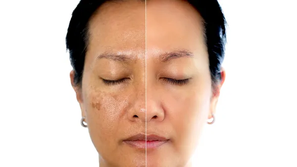 Skin-Discoloration-Before-After-Stock-Photo