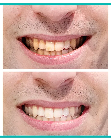 Supersmile Extra Whitening Pre-Rinse