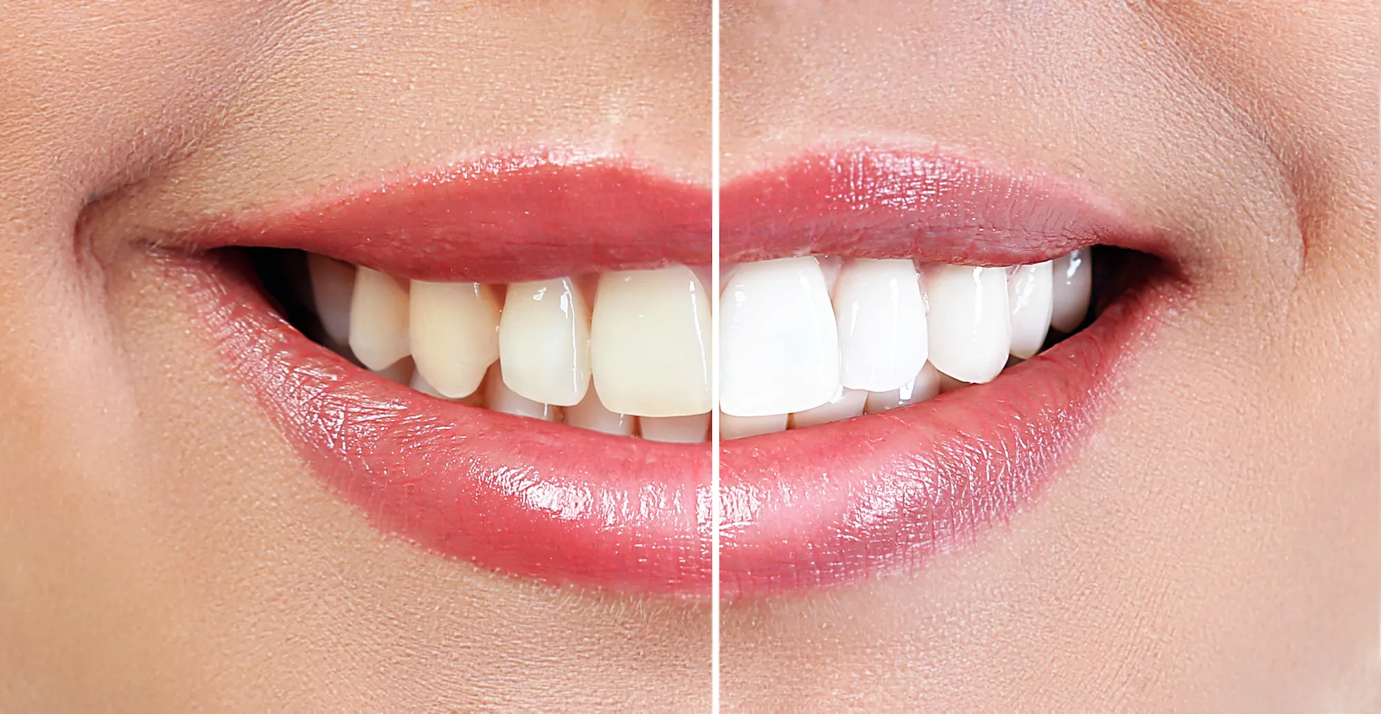 White-Teeth-Before-After-Stock-Photo