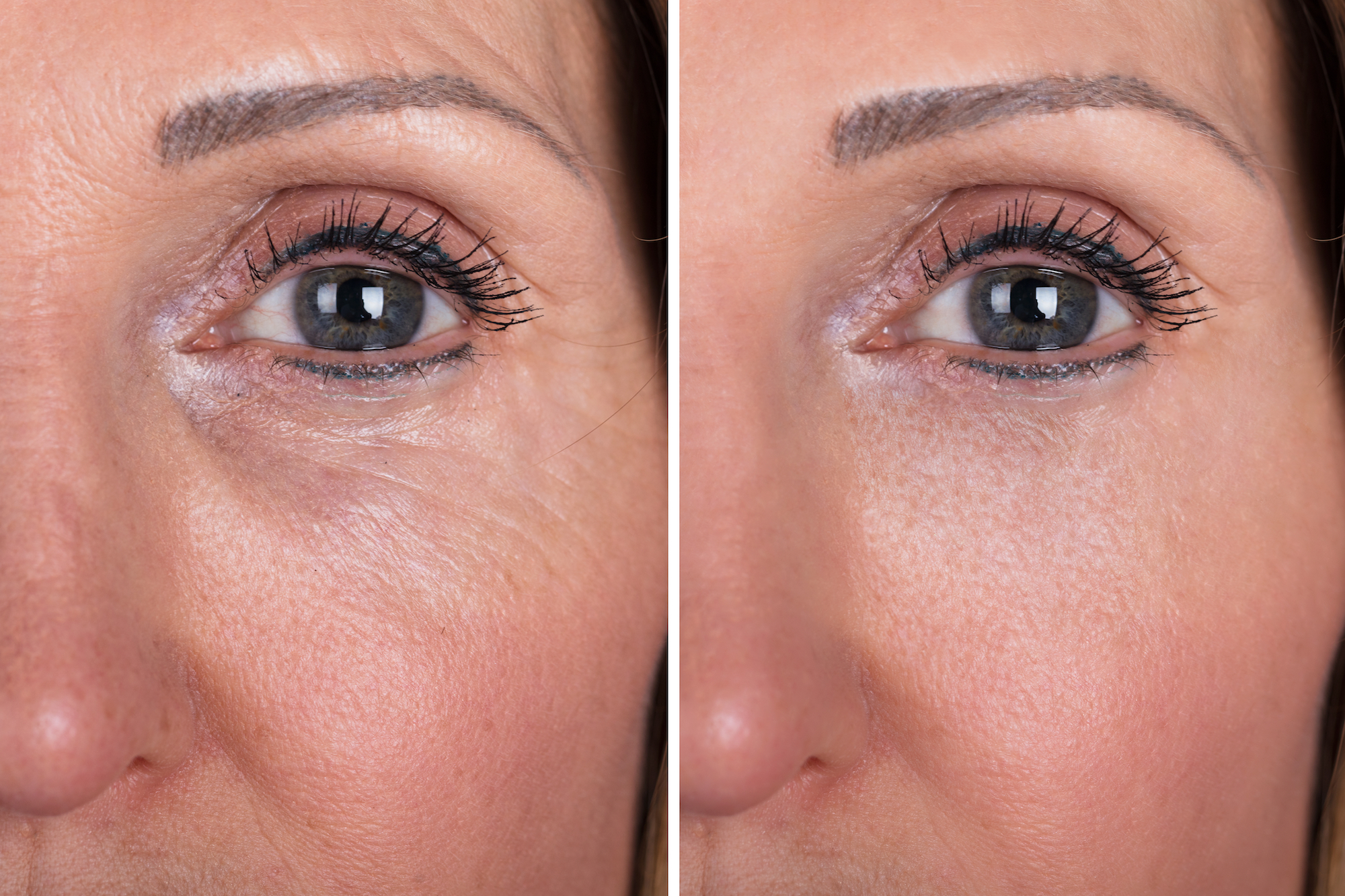 Wrinkle-Closeup-Before-After-Stock-Photo