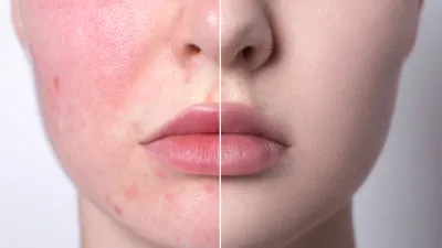 amazon-facetory-calming-facial-oil-anti-redness