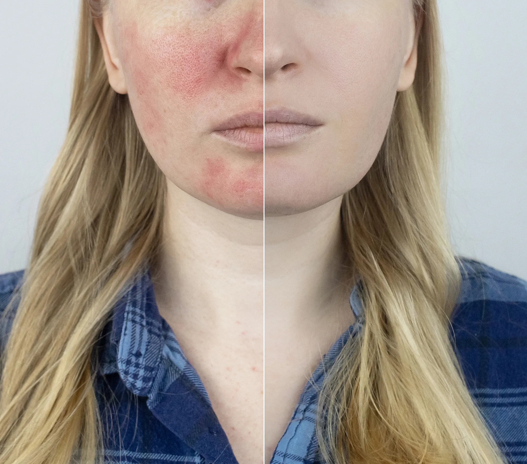 evian-facial-spray-red-irritatated-skin-before-after