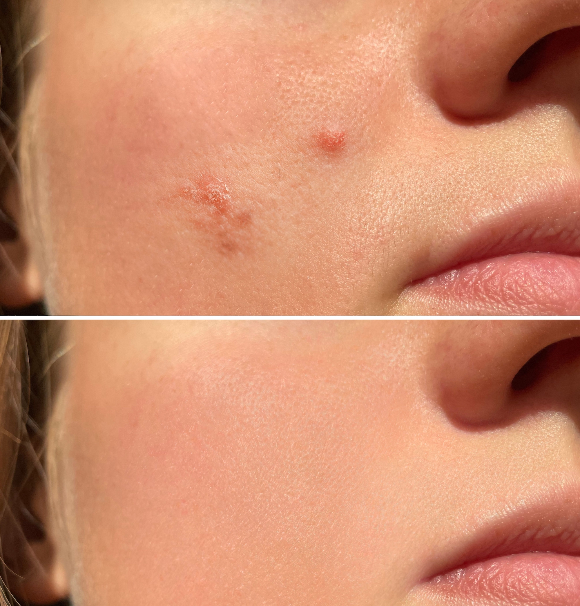 Acne-Treatment-Before-After-Stock-Photo