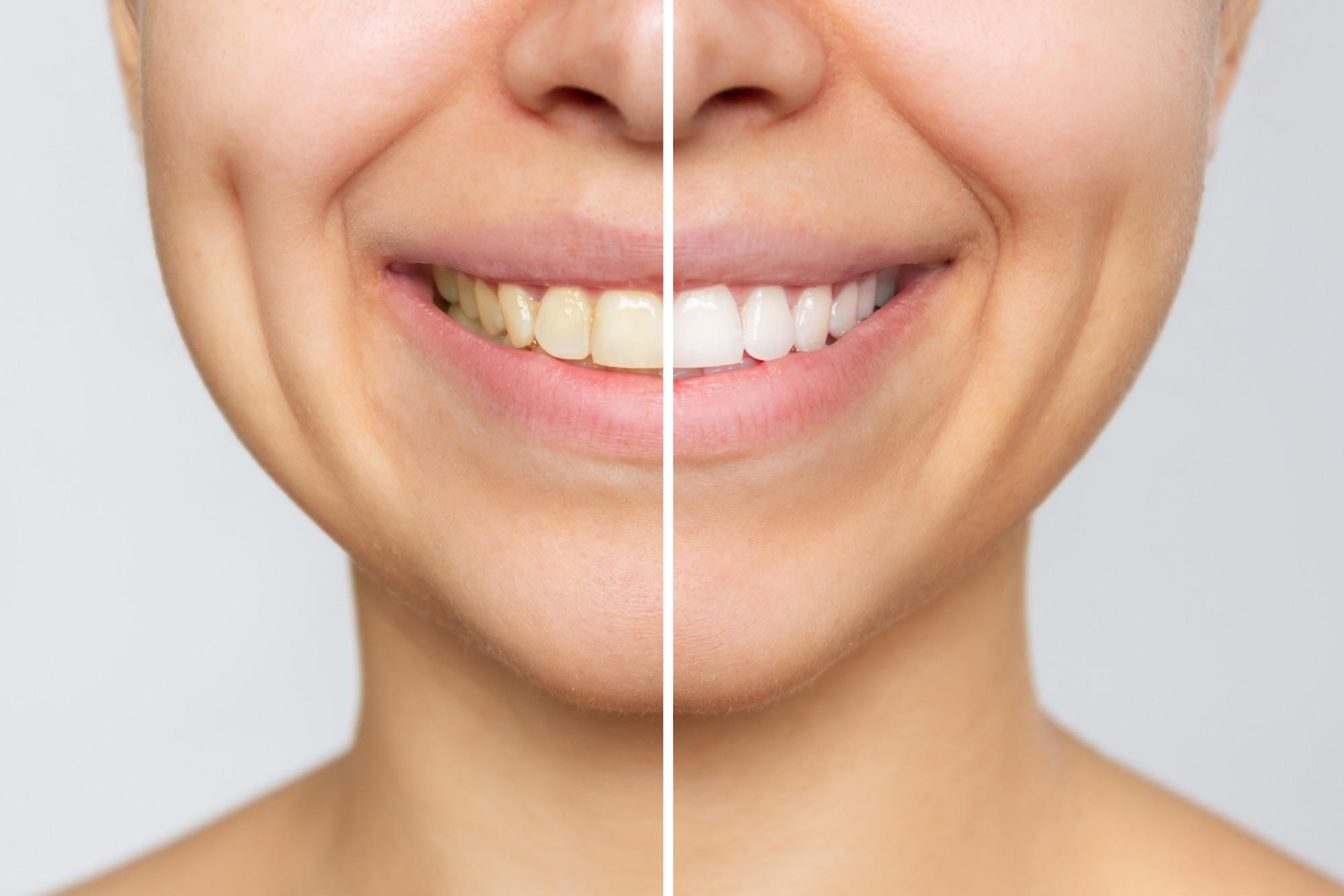 Before-and-After-Teeth-Cleaning-Stock-Photo