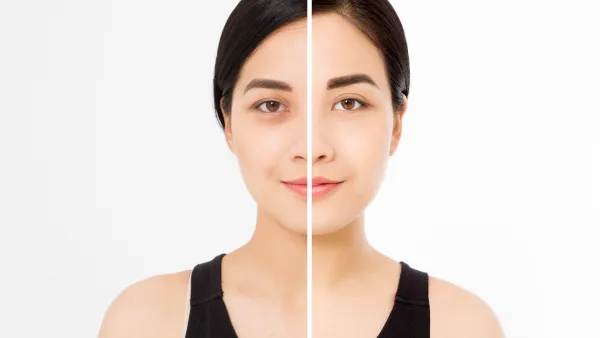 Dark-Circle-Before-After-Stock-Photo