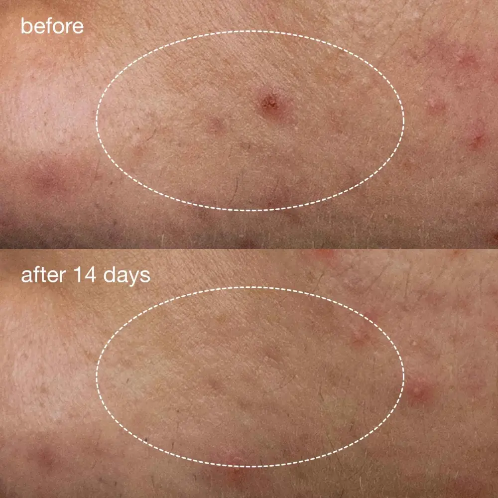 Deep Acne Invisible Liquid Patch