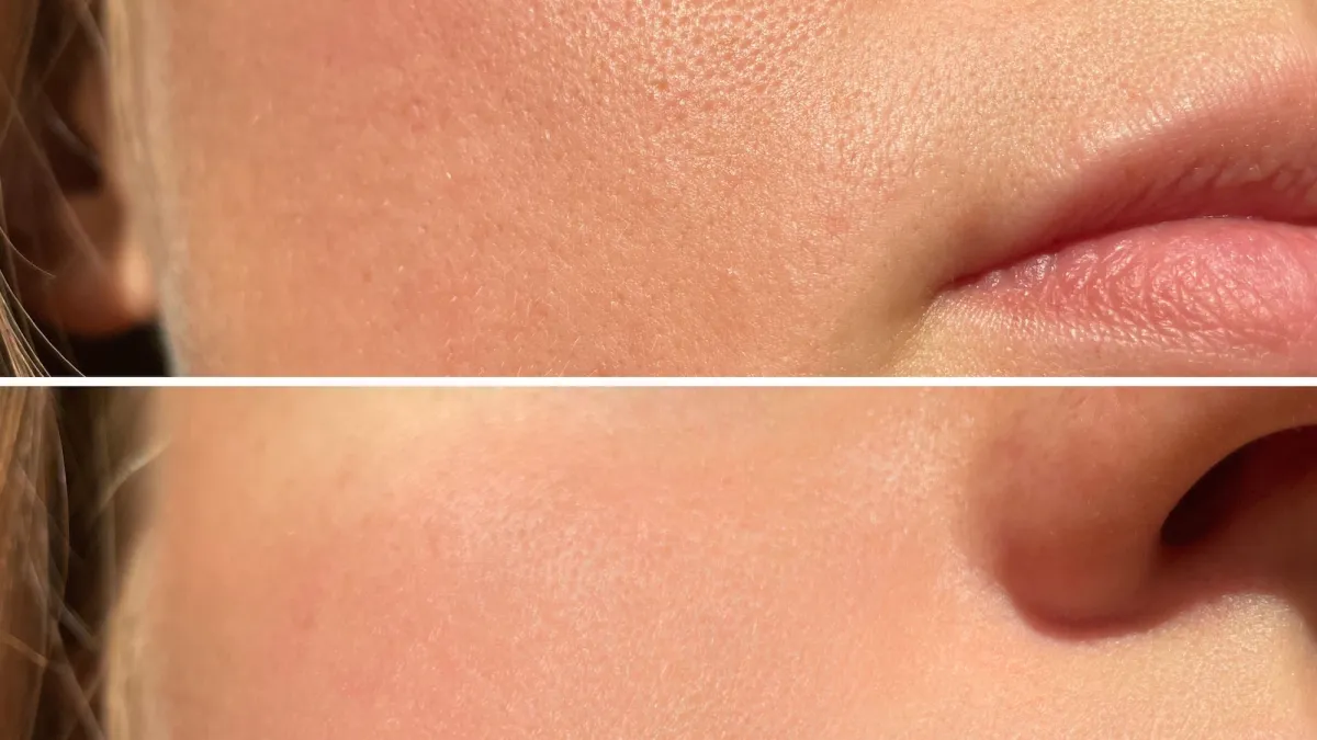 Skin-Pores-Bfore-After-Stock-Photo