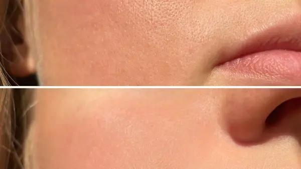 Skin-Pores-Bfore-After-Stock-Photo