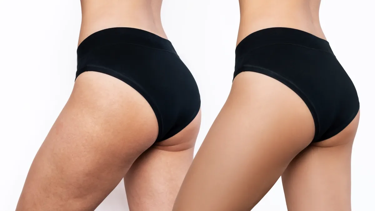 Best-Anti-Cellulite-Cream-Stock-Photo