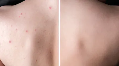 Body-Acne-Before-After-Stock-Photo