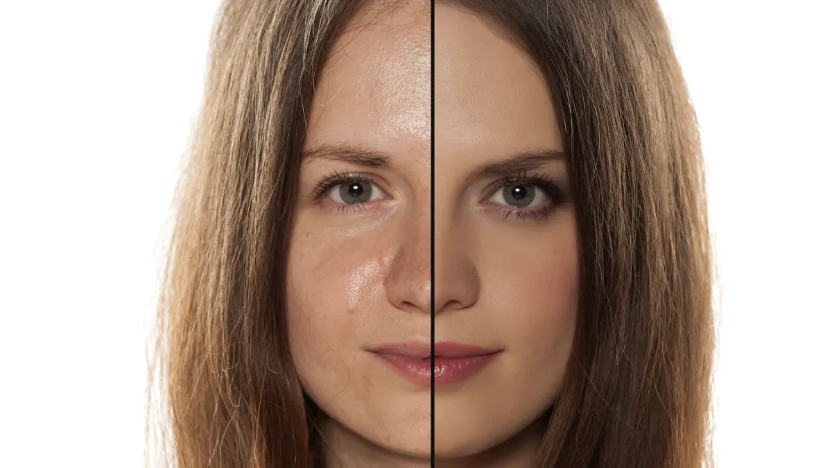 Oily-Skin-Before-After-Stock-Photo