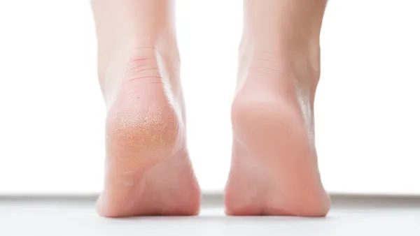 amazon-flexitol-heel-balm