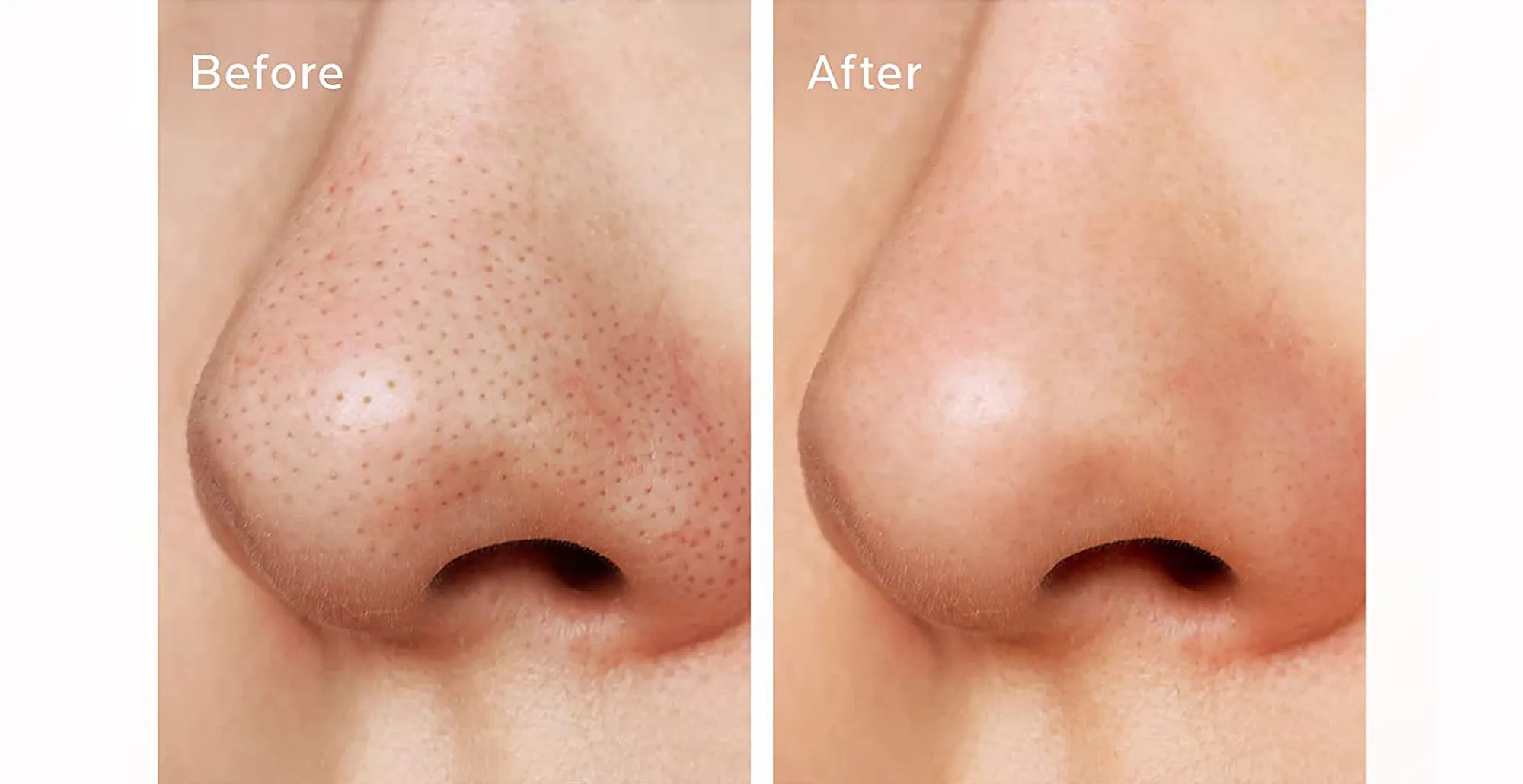 amazon-zealsea-strawberry-nose-pore-strip-kit