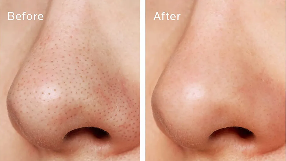 amazon-zealsea-strawberry-nose-pore-strip-kit