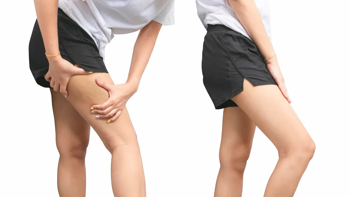 cellulite before and after